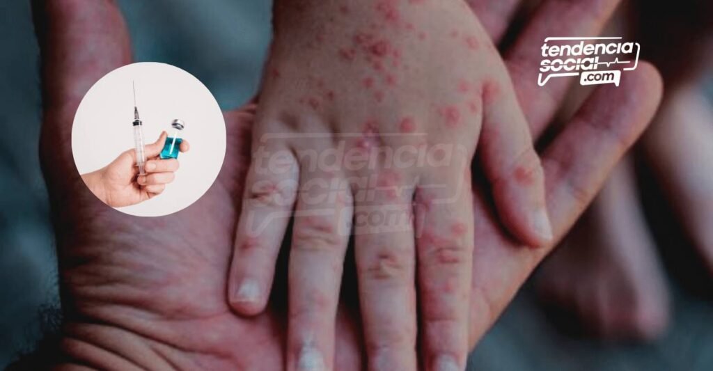 Por qué y dónde vacunar a los niños contra la rubéola y sarampión ¡Gratis!