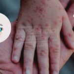 Por qué y dónde vacunar a los niños contra la rubéola y sarampión ¡Gratis!