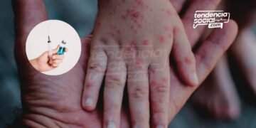 Por qué y dónde vacunar a los niños contra la rubéola y sarampión ¡Gratis!