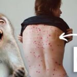 La viruela del mono llegó a Colombia tres casos son alarmantes ¡Conoce cuáles son los síntomas!