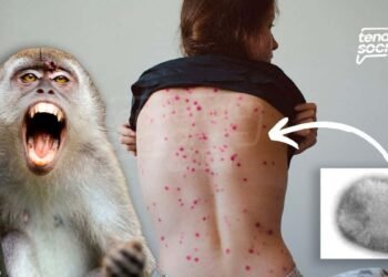 La viruela del mono llegó a Colombia tres casos son alarmantes ¡Conoce cuáles son los síntomas!
