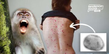 La viruela del mono llegó a Colombia tres casos son alarmantes ¡Conoce cuáles son los síntomas!
