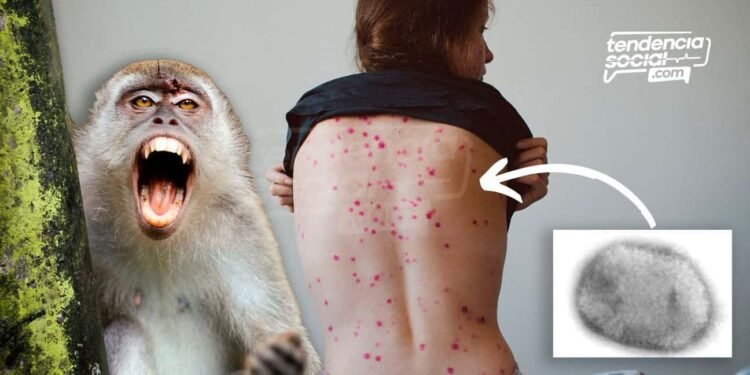 La viruela del mono llegó a Colombia tres casos son alarmantes ¡Conoce cuáles son los síntomas!